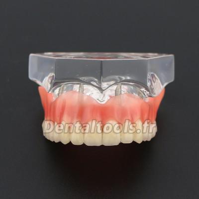 Prothèse Modèle Dentaire Couvert-dentier Inférieur avec 4 Implantations d’Étude de Démo Modèle 6001