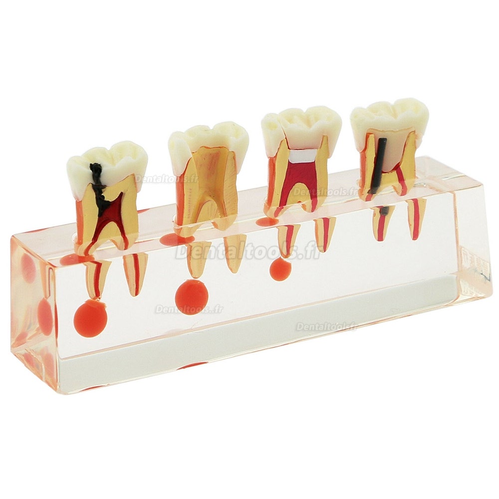 73/5000 Étude de traitement endodontique à 4 étapes de modèle de dents dentaires Teach Model 4018 01