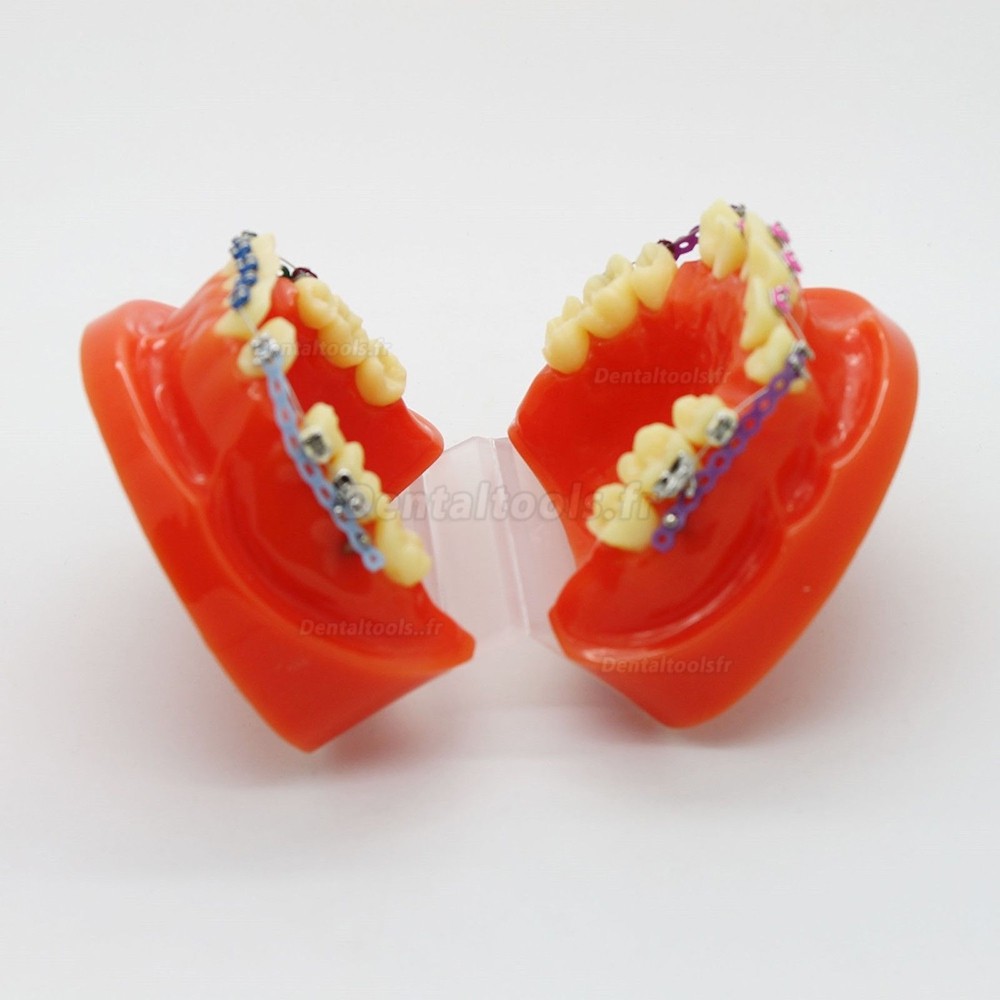 Modèle d'étude de traitement d'orthodontie dentaire avec support d'orthodontie et fil d'arc