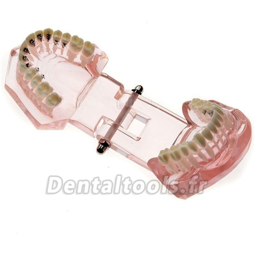 Modèle anatomique dentaire restauration linguale M-3004