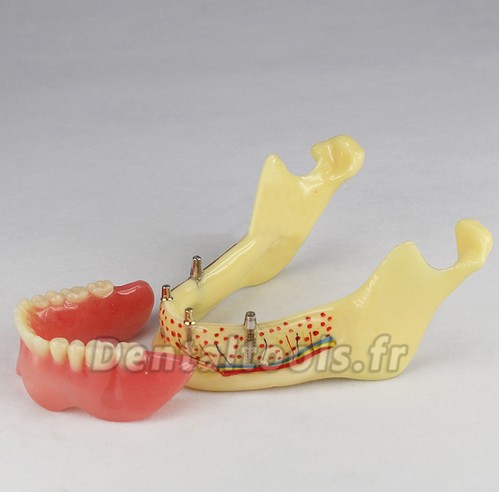 Modèle anatomique dentaire prothèse dentaire invisible M-2014b