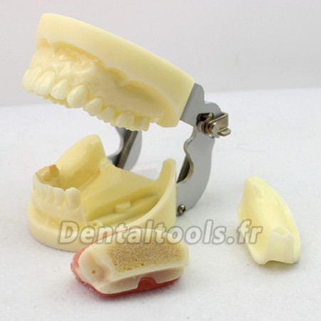 ENOVO Modèle d'exercice implant dentaire avec implant amovible ENOVO Modèle d'exercice implant dentaire avec implant amovible