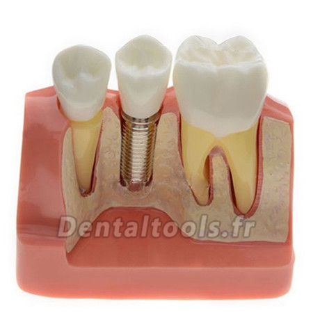 Modèle anatomique dentaire Analyse D'implant couronne dentaire M-2017