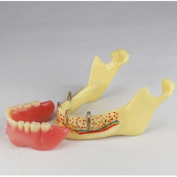 Modèle anatomique dentaire prothèse dentaire invisible M-2014b
