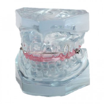 Modèle anatomique dentaire de la contention après le traitement orthodontique M-...