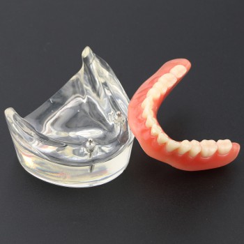 Modèle Dentaire Couvert-dentier Inférieur avec 2 Implantations d’Étude de Démo M...