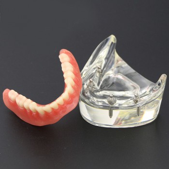 Modèle 6002 02 d’Overdenture Inférieure d’Étude de Démo de Dents Inférieures ave...