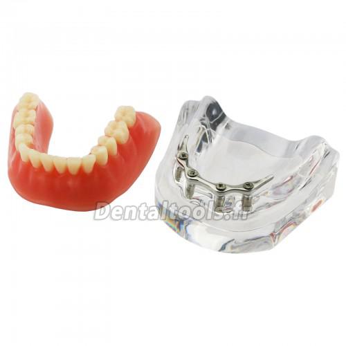 Dentaire inférieur Modèle de dents Overdenture Précision 4 implants Manifestation Bar d'Argent