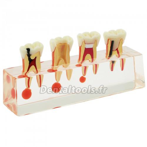 73/5000 Étude de traitement endodontique à 4 étapes de modèle de dents dentaires Teach Model 4018 01