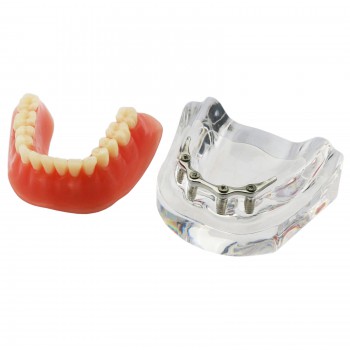 Dentaire inférieur Modèle de dents Overdenture Précision 4 implants Manifestatio...
