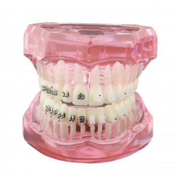 Modèle de Dents Dentaire Orthodontique Bracket métal et céramique étude 3003