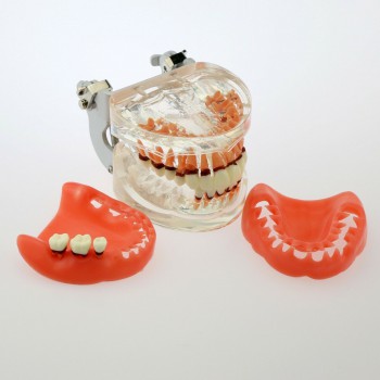 Modèle dentaire Modèle d'étude de la maladie parodontale pathologique chez l'adu...
