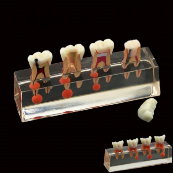 Traitement endodontique en 4 étapes du modèle de dents dentaires démontre le M4018-01 anatomique