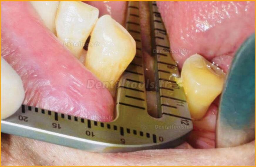 Ensemble de chirurgie d'implant dentaire acier inoxydable instrument de positionnement de plantation orale
