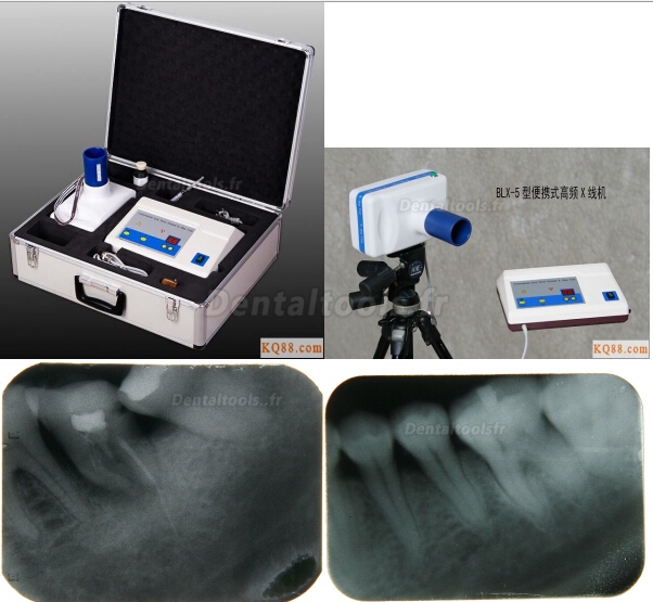 BLX-5 Appareil Radiographique dentaire portable