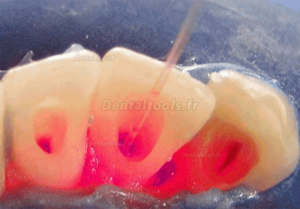 Stylo de thérapie laser parodontale pour tissus mous sans fil laser à diode dentaire
