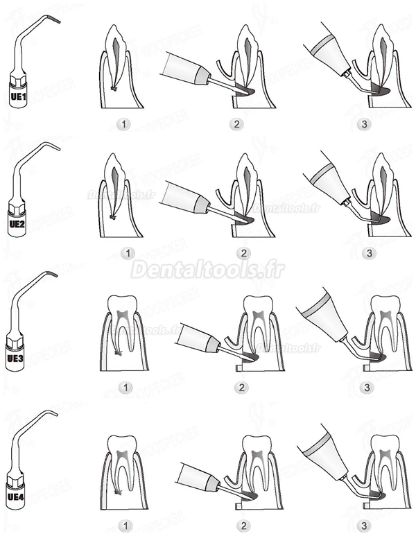 WOODPECKER® INSERTS A PIEZO CHIRURGIE ENDODONTIE KIT 4 INSERTS