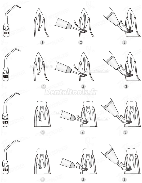 WOODPECKER® INSERTS A PIEZO CHIRURGIE ENDODONTIE KIT 4 INSERTS