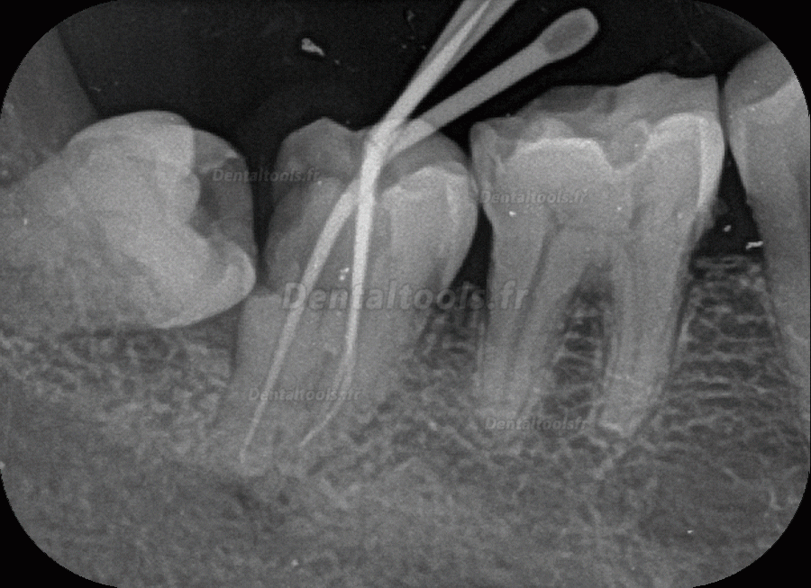 Fussen F200 Scanner de Plaque au Phosphore Système de Radiologie Numérique par Plaque au Phosphore