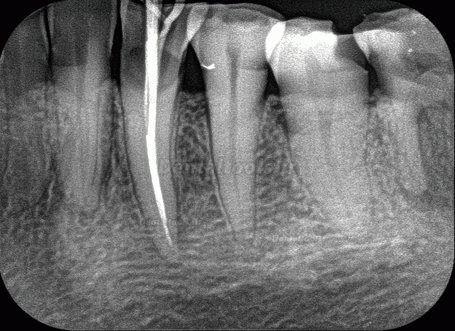 Fussen F200 Scanner de Plaque au Phosphore Système de Radiologie Numérique par Plaque au Phosphore