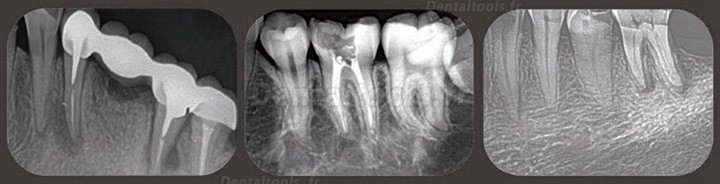 Fussen F200 Scanner de Plaque au Phosphore Système de Radiologie Numérique par Plaque au Phosphore