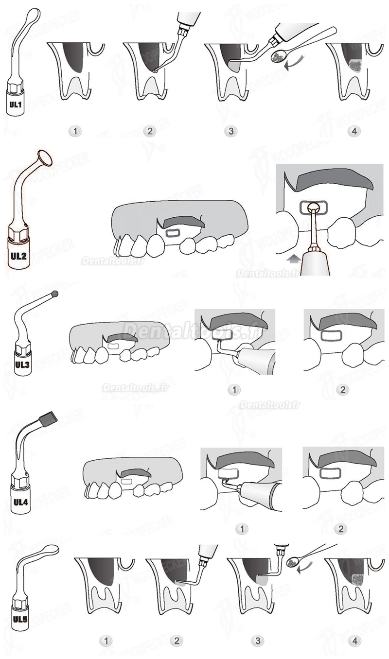 WOODPECKER® INSERTS A PIEZO CHIRURGIE SINUS LIFT KIT