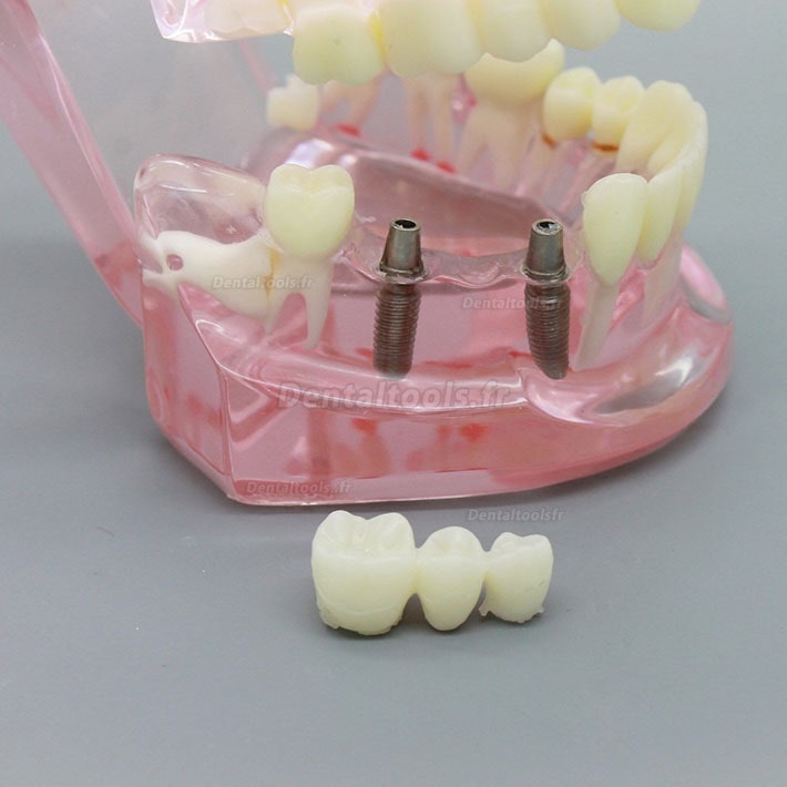 Modèle de dents de démonstration avec analyse d'étude sur implants dentaires avec restauration 2001 rose