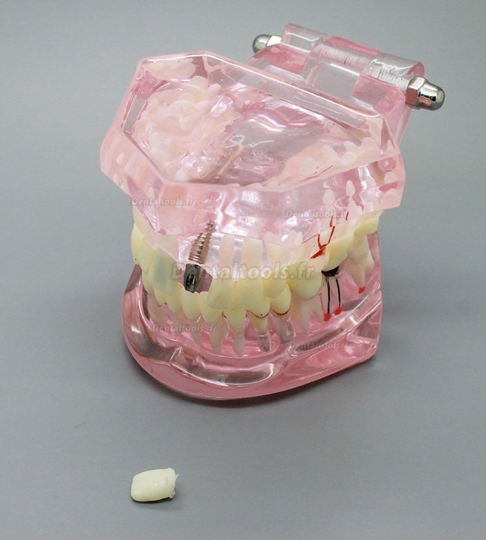 Modèle de dents de démonstration avec analyse d'étude sur implants dentaires avec restauration 2001 rose