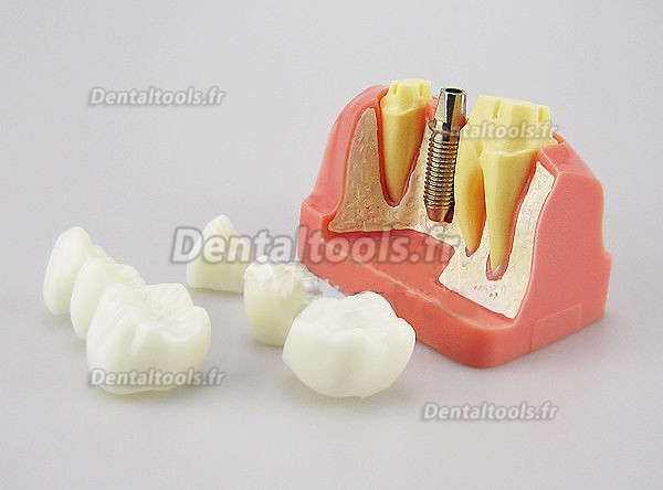 Modèle anatomique dentaire Analyse D'implant couronne dentaire M-2017