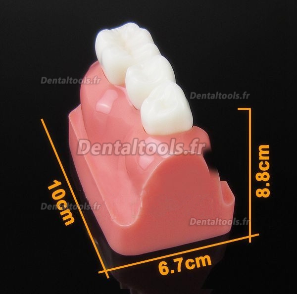 Modèle anatomique dentaire Analyse D'implant couronne dentaire M-2017