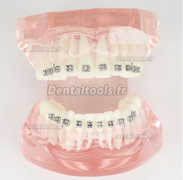 Modèle de traitement d'orthodontie dentaire dents de démonstration Supports métalliques 3001