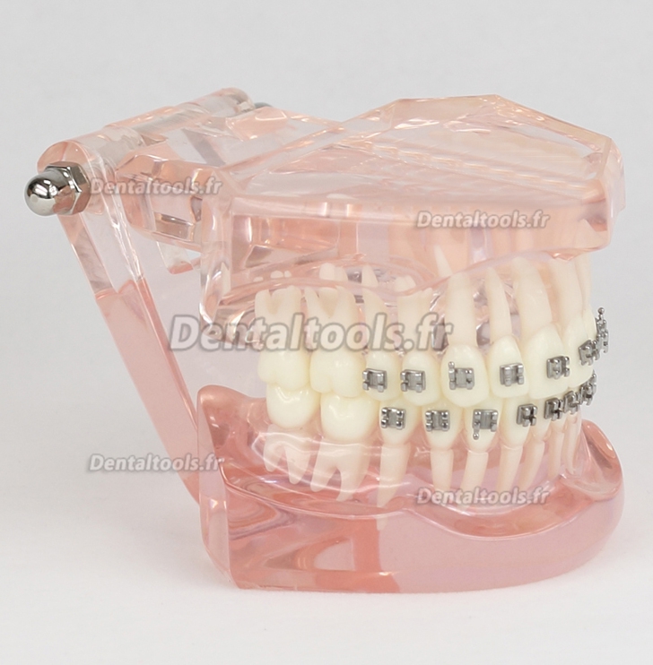 Modèle de traitement d'orthodontie dentaire dents de démonstration Supports métalliques 3001