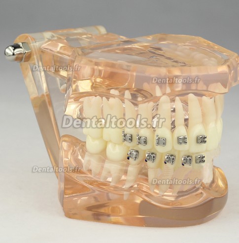 Modèle anatomique dentaire/Orthodontie Contraste des brackets M3009
