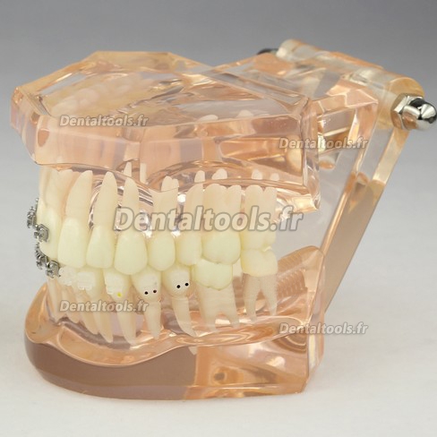 Modèle anatomique dentaire/Orthodontie Contraste des brackets M3009