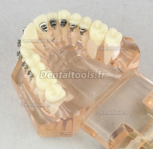 Modèle anatomique dentaire/Orthodontie Contraste des brackets M3009