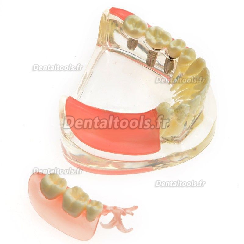 Modèle anatomique dentaire Restauration implantaire pour molaires perdues M-6006