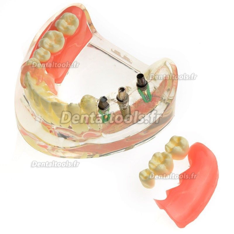 Modèle anatomique dentaire Restauration implantaire pour molaires perdues M-6006