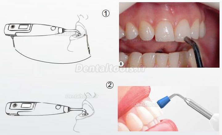 Denjoy MeteEndo Système d'unité de chariot endo intégré dentaire mobile (Moteur endo + testeur de pulpe + localisateur d'apex + système d'obturation)