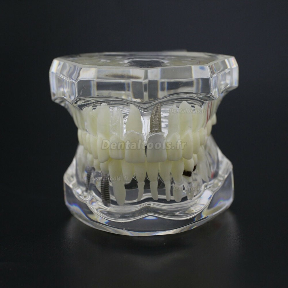 Modèle d'implant démonstration dentaire pour les maladies des dents de Caries Parodonte Rose Transparent