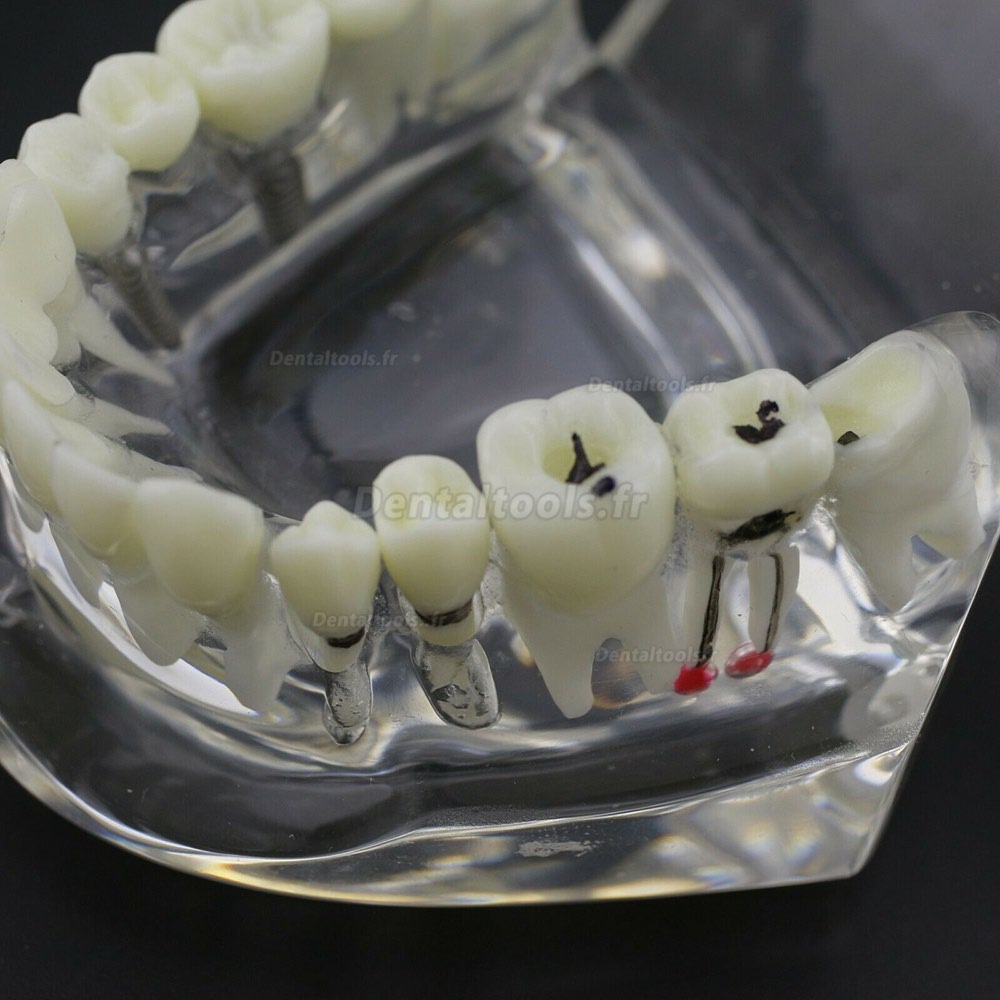 Modèle d'implant démonstration dentaire pour les maladies des dents de Caries Parodonte Rose Transparent