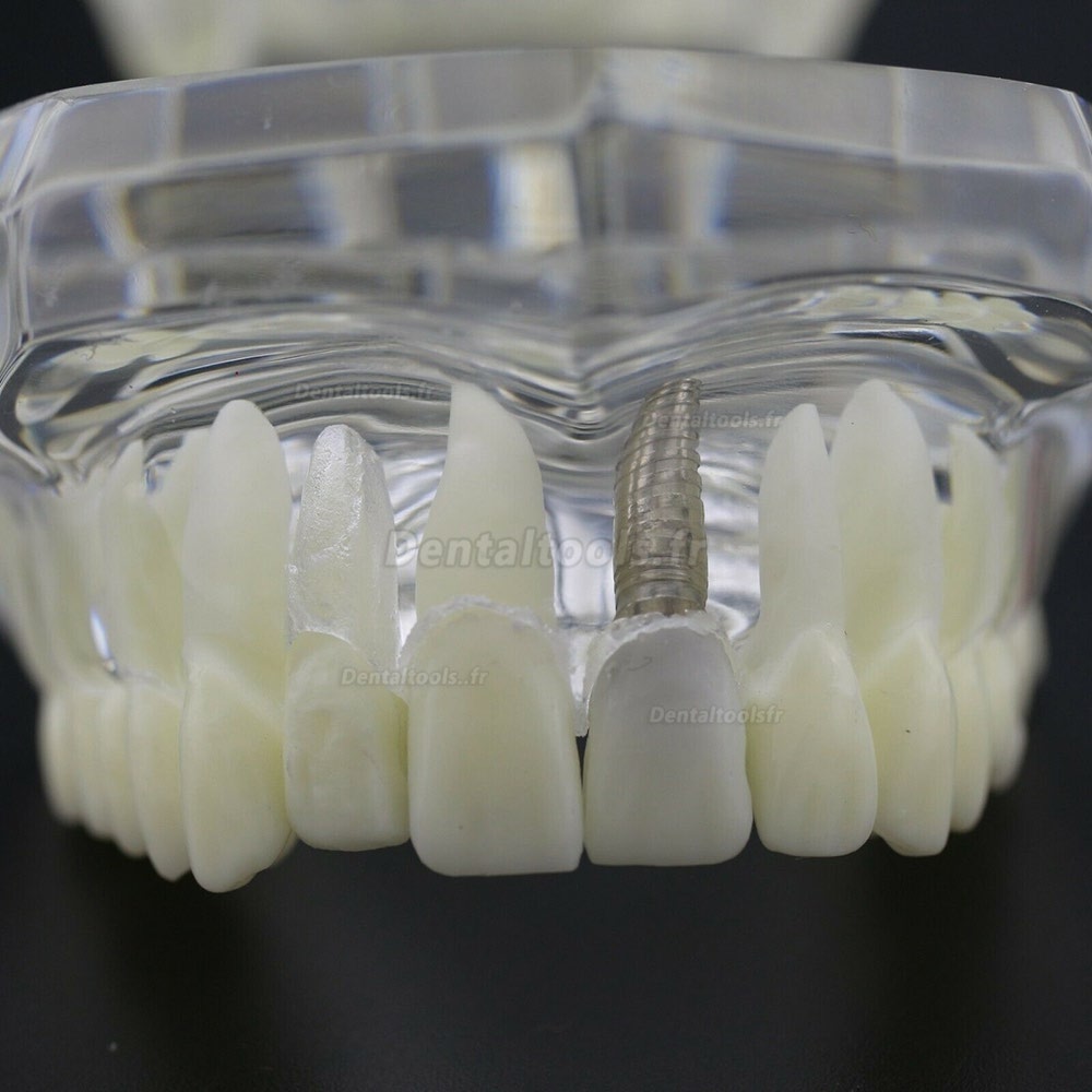 Modèle d'implant démonstration dentaire pour les maladies des dents de Caries Parodonte Rose Transparent