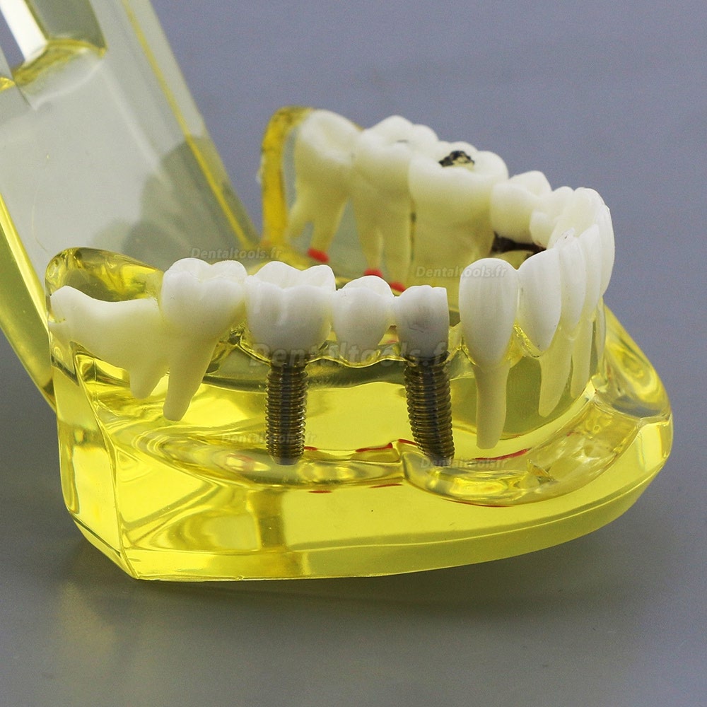 Modèle de dents dentaires Etude Teach Etude d'implantation orale Restauration et pathologie 2001 Jaune