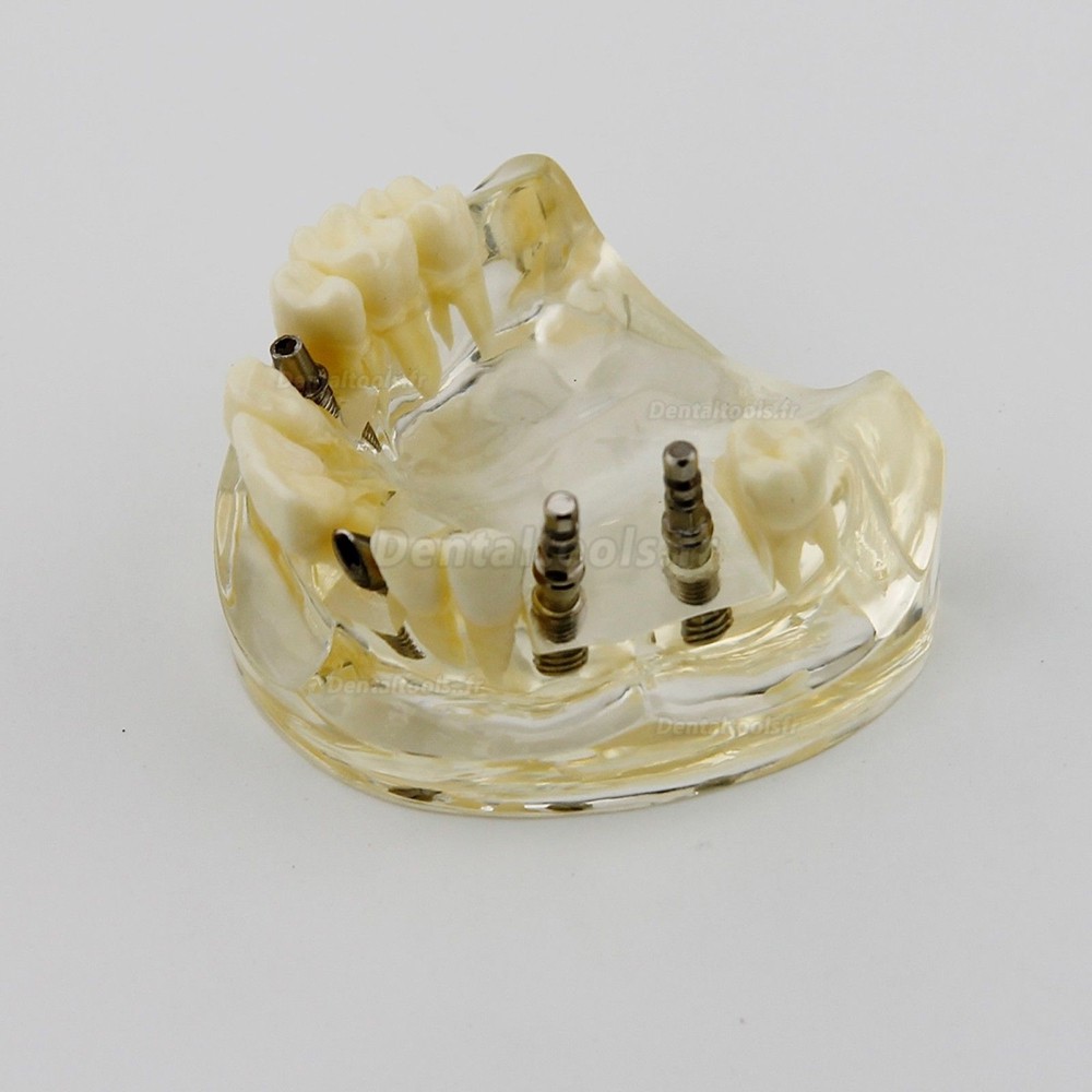 Gencive remplaçable dentaire Modèle de pratique de l'implant complet 2002