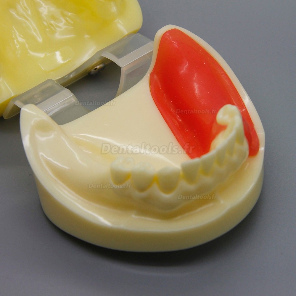Dentaire Gencive remplaçable Modèle de pratique de l'implant complet 2002