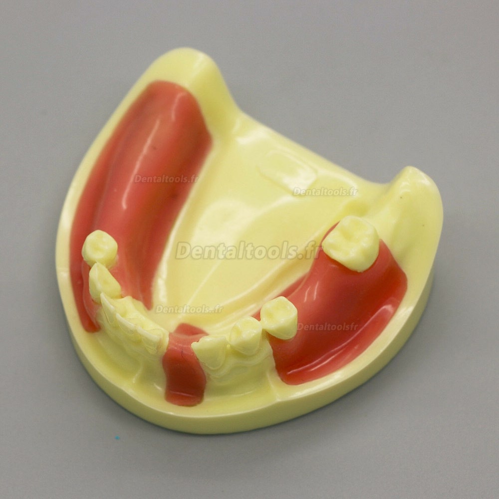Modèle dentaire #2004 01 - Modèle de pratique d'implant de la mâchoire inférieure avec gencive