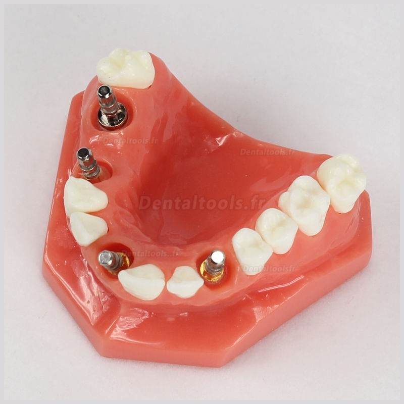 Modèle dentaire d'implant de mâchoire supérieure (Rouge) avec 5 implant # 2012 01