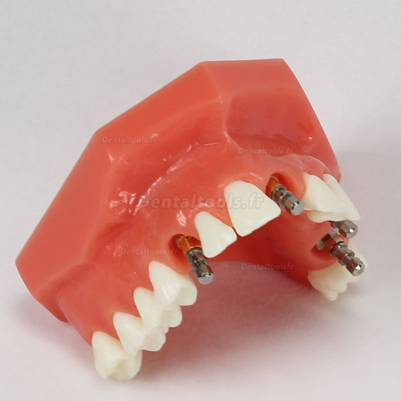 Modèle dentaire d'implant de mâchoire supérieure (Rouge) avec 5 implant # 2012 01