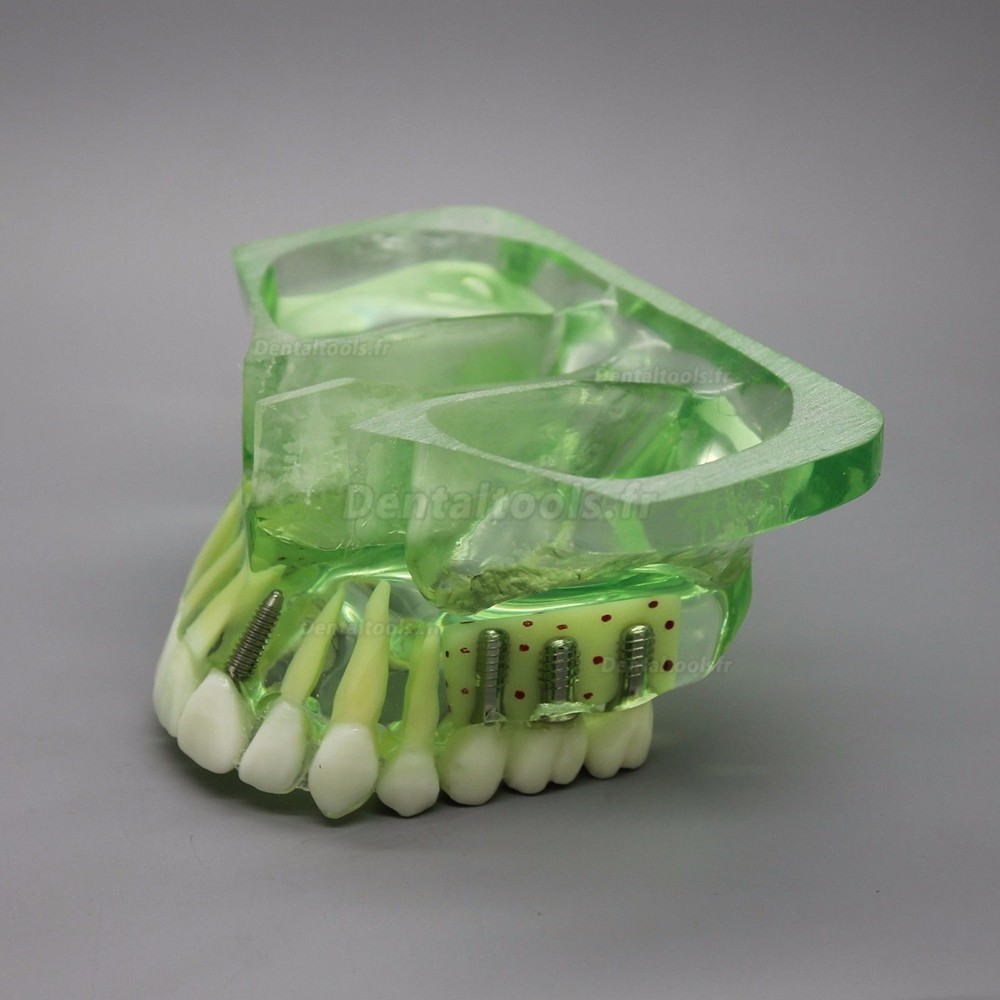 Modèle dentaire # 2015 01 - Modèle d'implant de mâchoire supérieure avec sinus