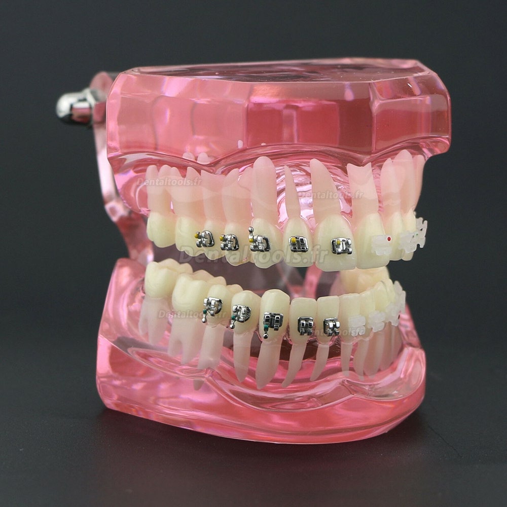 Modèle de Dents Dentaire Orthodontique Bracket métal et céramique étude 3003