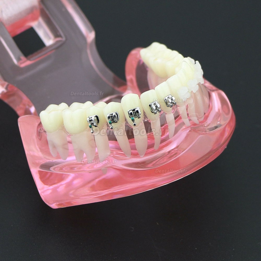 Modèle de Dents Dentaire Orthodontique Bracket métal et céramique étude 3003